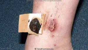 herz-op-wunden_008-mini.webp