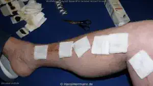 herz-op-wunden_045-mini.webp