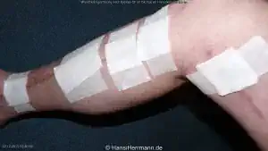 herz-op-wunden_049-mini.webp