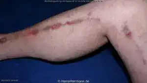 herz-op-wunden_051-mini.webp