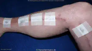 herz-op-wunden_053-mini.webp