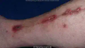 herz-op-wunden_054-mini.webp