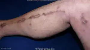 herz-op-wunden_060-mini.webp