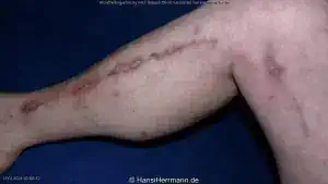 herz-op-wunden_062-mini.webp
