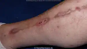 herz-op-wunden_063-mini.webp